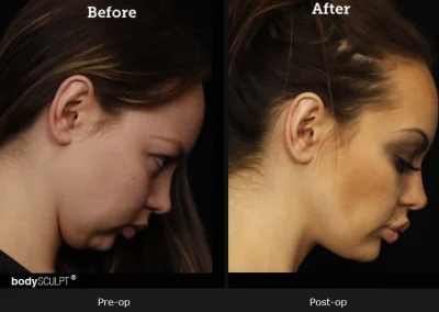 Chin Implant Surgery