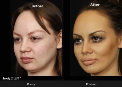 Chin Implant Surgery