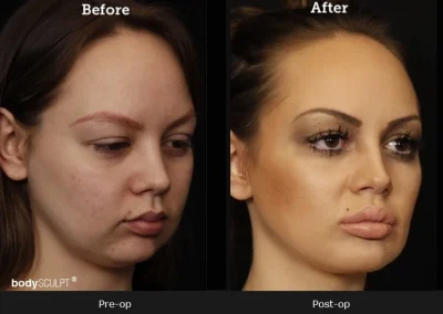 Chin Implant Surgery