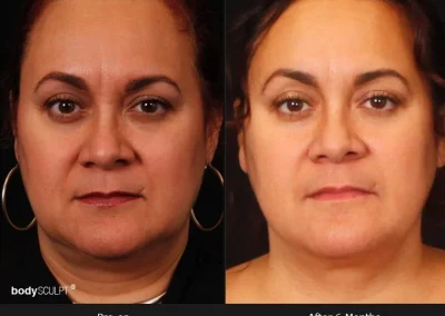 Embrace-RF – Before & After Photos