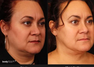 Embrace-RF – Before & After Photos