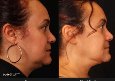 Embrace-RF – Before & After Photos