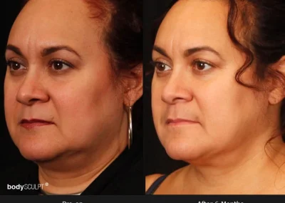 Embrace-RF – Before & After Photos