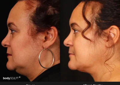 Embrace-RF – Before & After Photos