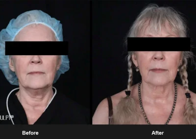 Embrace-RF – Before & After Photos