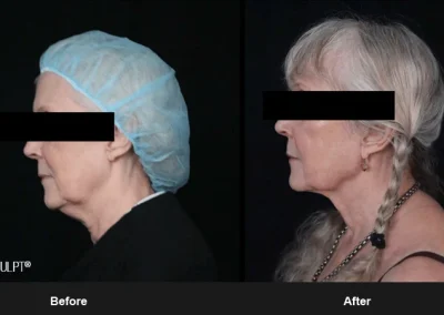 Embrace-RF – Before & After Photos