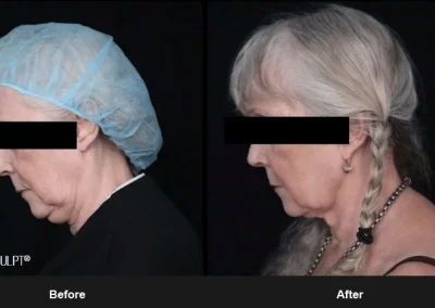 Embrace-RF – Before & After Photos