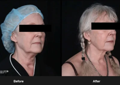 Embrace-RF – Before & After Photos