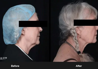 Embrace-RF – Before & After Photos