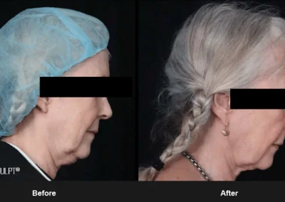 Embrace-RF – Before & After Photos