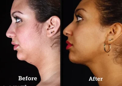 Facetite & Necktite