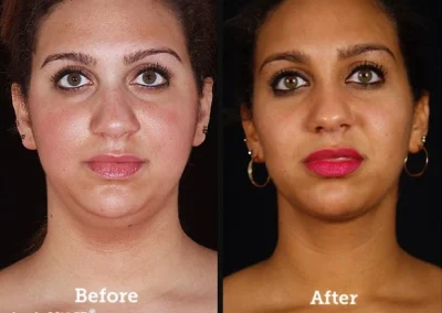 FaceTite / NeckTite with RFAL