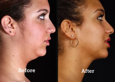 FaceTite / NeckTite with RFAL