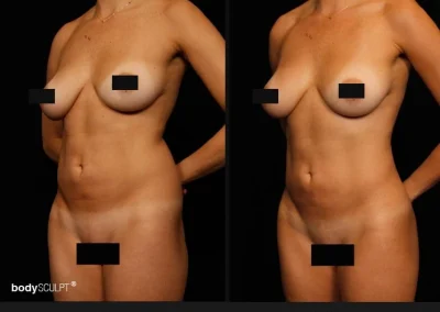 Hi Def Liposuction for Women