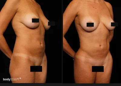 Hi Def Liposuction for Women