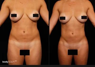 Hi Def Liposuction for Women