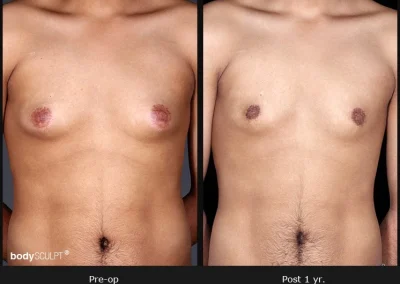 Gynecomastia