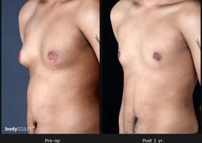 Gynecomastia - Before & After