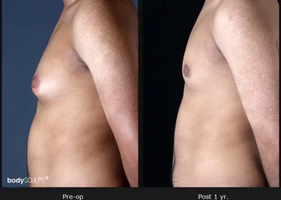 Gynecomastia