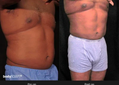 Male Body Contouring -Before/After Photos
