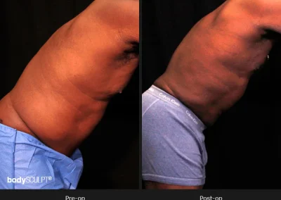 Male Body Contouring -Before/After Photos
