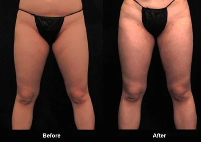 BodyTite Medial Thigh Contouring