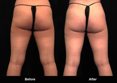 BodyTite Medial Thigh Contouring