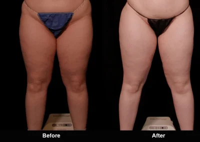 BodyTite Medial Thigh Contouring