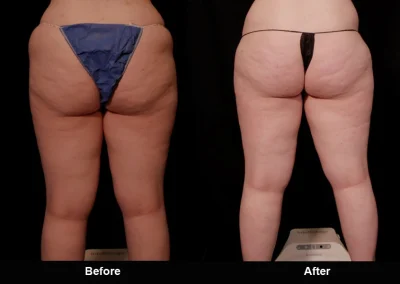 BodyTite Medial Thigh Contouring