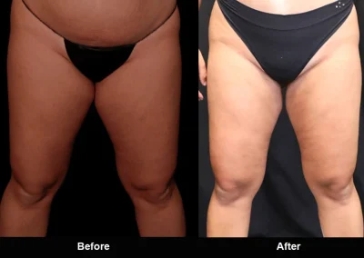 BodyTite Medial Thigh Contouring