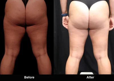 BodyTite Medial Thigh Contouring