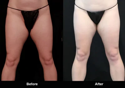 BodyTite Medial Thigh Contouring
