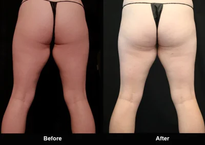 BodyTite Medial Thigh Contouring
