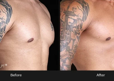 Pectoral Implants - Before & After Photos