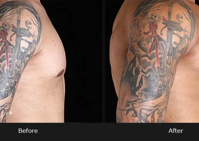 Pectoral Implants – Before & After Photos
