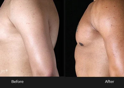 Pectoral Implants – Before & After Photos