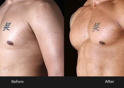 Pectoral Implants - Before & After Photos