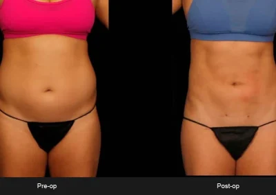 BodyTite Liposuction for Abdomen