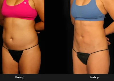 BodyTite Liposuction for Abdomen