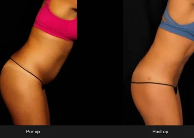 BodyTite Liposuction for Abdomen