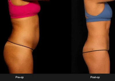 BodyTite Liposuction for Abdomen