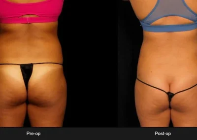 BodyTite Liposuction for Abdomen