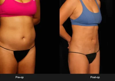 BodyTite Liposuction for Abdomen