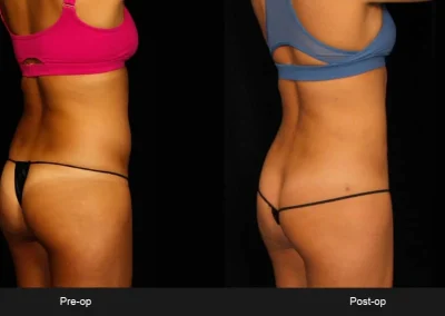 BodyTite Liposuction for Abdomen