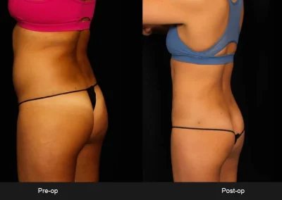 BodyTite Liposuction for Abdomen