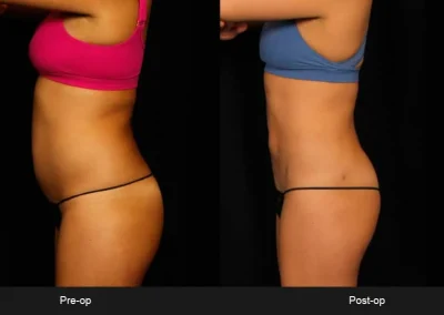 BodyTite Liposuction for Abdomen