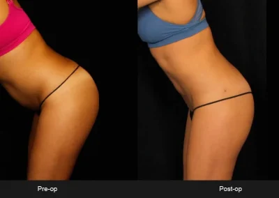 BodyTite Liposuction for Women - Before & After Photos