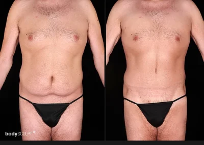 Tummy Tuck for Men
