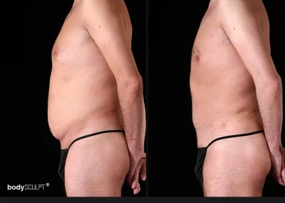 Tummy Tuck for Men - Before & After Photos