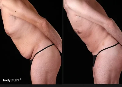 Tummy Tuck for Men